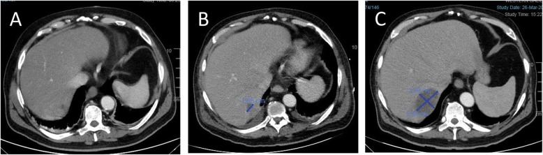 Liver abscess development on consecutive double contrast abdominal computed tomography scans. Scans were done on days 3 (a) 7 (b) and 26 (c) post-endoscopic retrograde cholangiopancreatography