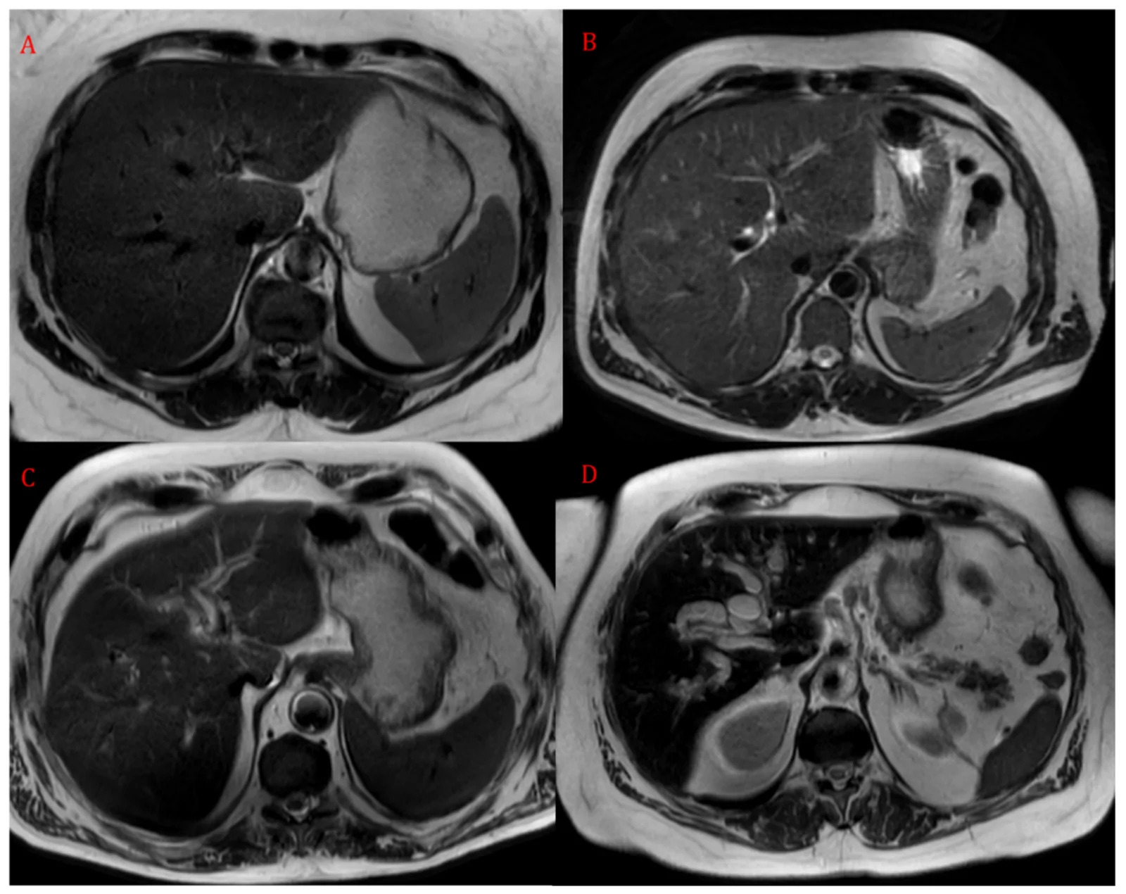 Axial T2-weighted MR images illustrating IHBD dilatation: (A) absent, grade 0; (B) mild, grade 1; (C) moderate, grade 2; and (D) severe, grade 3.