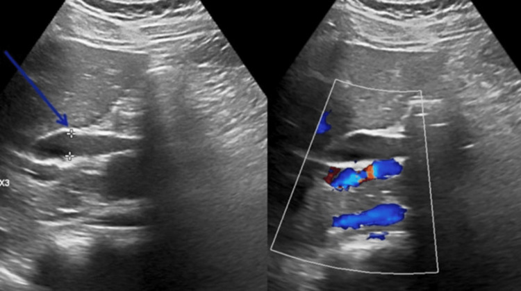 Abdominal ultrasoundA transverse image demonstrating a dilated common bile duct, measuring 10 mm in diameter (indicated by calipers). This finding of biliary dilatation without evidence of choledocholithiasis prompted further cross-sectional imaging. The gallbladder and peripancreatic region are not well visualized in this image due to technical limitations and bowel gas interference.