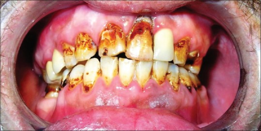 Generalized cervical caries with recessions in a 40-year-old patient inhaled burnt heroin fumes for 10 years