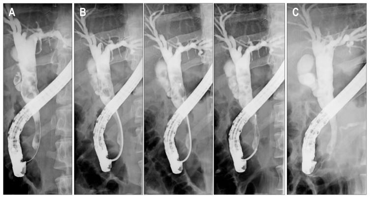 (A) Endoscopic retrograde cholangiogram showing multiple variably sized stones in a stemware-shaped common bile duct (CBD). (B) Multiple sessions of mechanical lithotripsy were performed in the dilated proximal CBD. (C) No residual stone was observed in the stemware-shaped CBD by cholangiography that was performed after stone removal using a basket and an extraction balloon catheter.