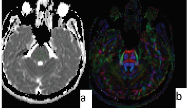 Male, 32 years old, control group. ADC map (a) and FA map (b) can be seen. ROI is placed on the brainstem. ADC value is 741; FA value is 440 (similar to the control group).