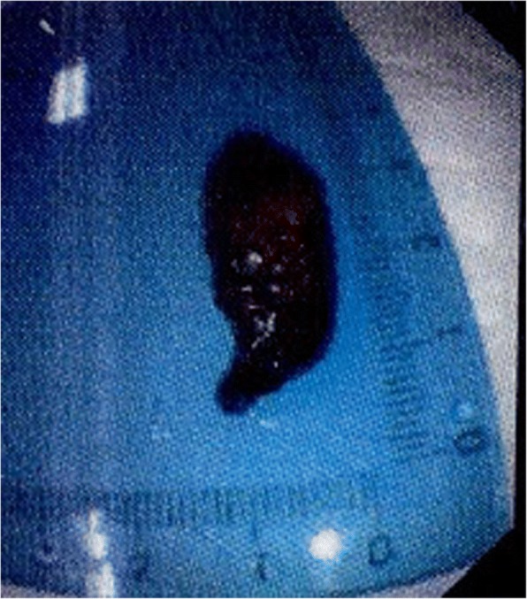 A blood clot (maximum diameter 3.5 cm × 1.0 cm)