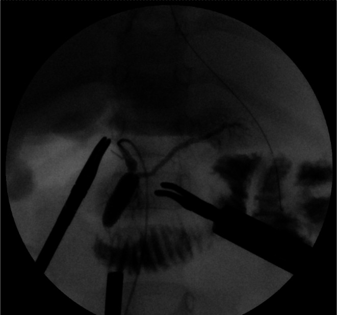 Intraoperative cholangiography. Intraoperative cholangiography revealed a protein plug within the common channel, resulting in poor contrast passage into the duodenum. Repeated irrigation improved contrast flow, although the protein plug remained partially visible.