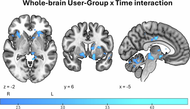 Regions showing reduced reward anticipation activity from baseline to follow-up in PWUC relative to controls in a whole-brain exploratory t-test.PWUC – people who use cannabis. Results from a whole-brain independent-samples t-test comparing the PWUC and control groups on changes in reward anticipation activity from baseline to follow-up. The analysis was run in the full sample of n = 96 and with a cluster-defining threshold Z = 2.3.
