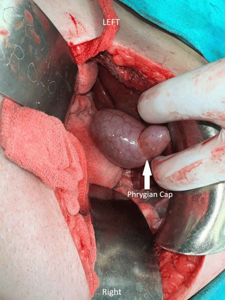 Phrygian cap of the gallbladder (white arrow)