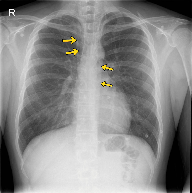 Chest radiograph showing pneumomediastinum