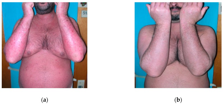 A 34-year-old patient with erythrodermic psoriasis that underwent secukinumab therapy. (a) Erythrodermic patient before treatment, (b) Patient after three weeks of secukinumab treatment.