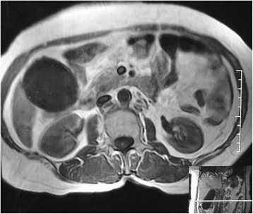 MRI showing mucocele of gall bladder (transverse plane)