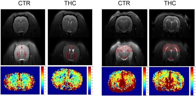 ASL image in the THC model. The figure shows anatomical (T2 weighted) images in the top part, the delineation of regions of interest for the ASL analysis (central part) and perfusion map (bottom part) in one representative animal from each CTR and THC exposed group. ROIs are numbered as follows. At +1.6 mm position from bregma: 1 – prefrontal cortex, 2 – caudate putamen; at −3.14 mm position from bregma: 3 – sensorimotor cortex, 4 – hippocampus, 5 – circle of Willis.