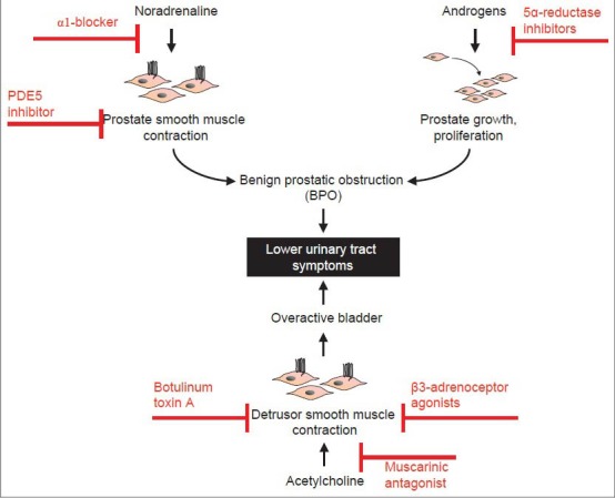 Pathophysiology and medical therapy of LUTS. Obstructive symptoms are frequently explained by benign prostatic obstruction, due to enhanced prostate smooth muscle tone and prostate enlargement. Both may contribute to urethral obstruction. Application of α1-blockers or PDE5 inhibitors cause improvement of obstructive symptoms by relaxation of prostate smooth muscle, while beneficial effects of 5α-reductase inhibitors occur by reduction of prostate growth and volume. Storage symptoms (“irritative”) are often caused by an overactive bladder, due to overactivity of detrusor smooth muscle contraction. Consequently, available options for treatment of storage symptoms are based on relaxation and quiescing of bladder smooth muscle tone, by application of muscarinic receptor antagonists, β3-adrenoceptors agonists, or botulinum toxin A
