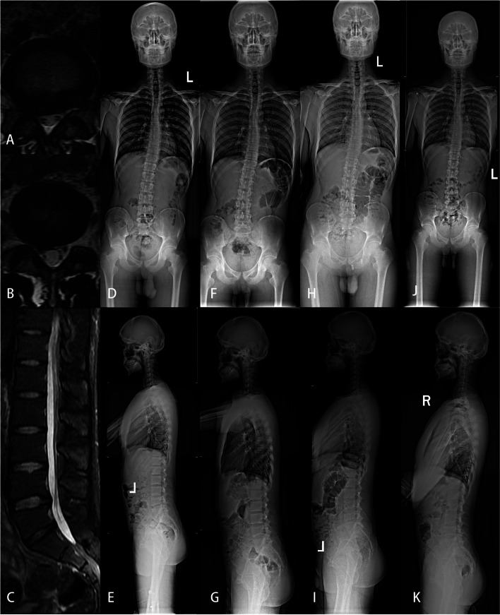 A 24-year-old male was admitted with “recurrent low back pain and right lower limb pain for more than one year”. He was diagnosed as lumbar disc herniation at L4/5 and L5/S1, and was treated with PELD in our hospital. A-E were preoperative lumbar magnetic resonance and whole spinal anteroposterior and lateral X-ray, A was L4/5 cross section, B was L5/S1 cross section, Cobb angle was 15.2 °; AVT:46.4 mm, CBD:54.2 mm, SVA:85.6 mm, TK:16.6 °, LL:41.4 °, PI:48.6 °; F-G were postoperative whole spinal positive and lateral X-ray, Cobb angle was 9.3°; AVT:45.4 mm, CBD:52.3 mm. SVA:84.1 mm, TK:17.7 °, LL:49.1 °; H-I: Cobb angle: 5.8 mm, AVT:39.7 mm, CBD: 40.5 mm, SV-A: 34.3 mm; TK: 17.8 mm, LL:49.4 °; J-K: Cobb angle: 3.9°, AVT:18.9 mm, CBD:28.7 mm, SVA:-2.2 mm, TK:20.1 °, LL:50.5 °