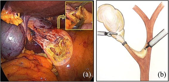 A V-shaped incision was made using electrocautery along the medial wall of the cystic duct and the lateral wall of the common hepatic duct, which comprise two sides of Calot’s triangle. (a) Operative view; (b) Illustration