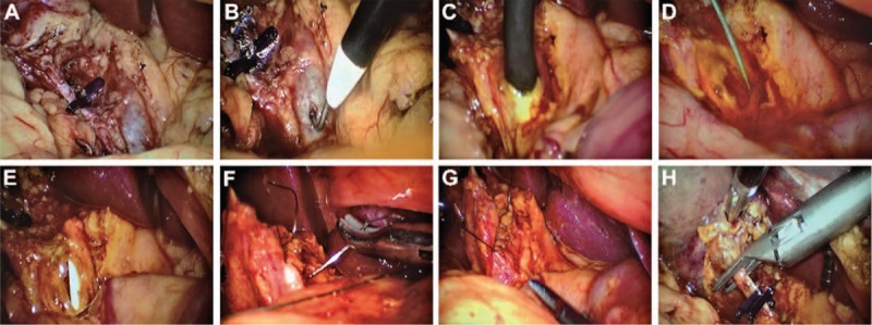 (A) The cystic artery and cystic duct were dissected and ligated using absorbable clips, but for retraction purposes; the cystic duct was not divided. (B) The anterior surface of the CBD was carefully dissected for about 2.5 cm, and the CBD was performed with a longitudinal incision (8–10 mm) made with electrocautery. (C) Choledochoscope was inserted in the CBD and the left and right hepatic ducts and the distal common bile duct explored. (D) The guidewire was placed into the CBD through the choledochoscope and advanced across the papilla into the duodenum. (E) Then the guidewire was removed out until the distal end of the spontaneously removable biliary stent drainage tube entered the duodenum and the proximal end remained in the CBD. (F) The longitudinal choledochotomy was closed with 4–0 absorbable suture. (G) Bile duct suture was completed. (H) The cystic duct was divided. CBD = common bile duct.