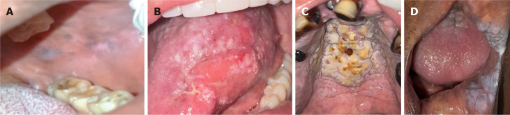 Intraoral photographs of observed lesions. A: Buccal mucosal leukoedema in a to-bacco smoker; B: In situ carcinoma of the tongue in an electronic cigarette user; C: Palate of an in-verted smoker; D: Verrucous leukoplakia in an inverted smoker.