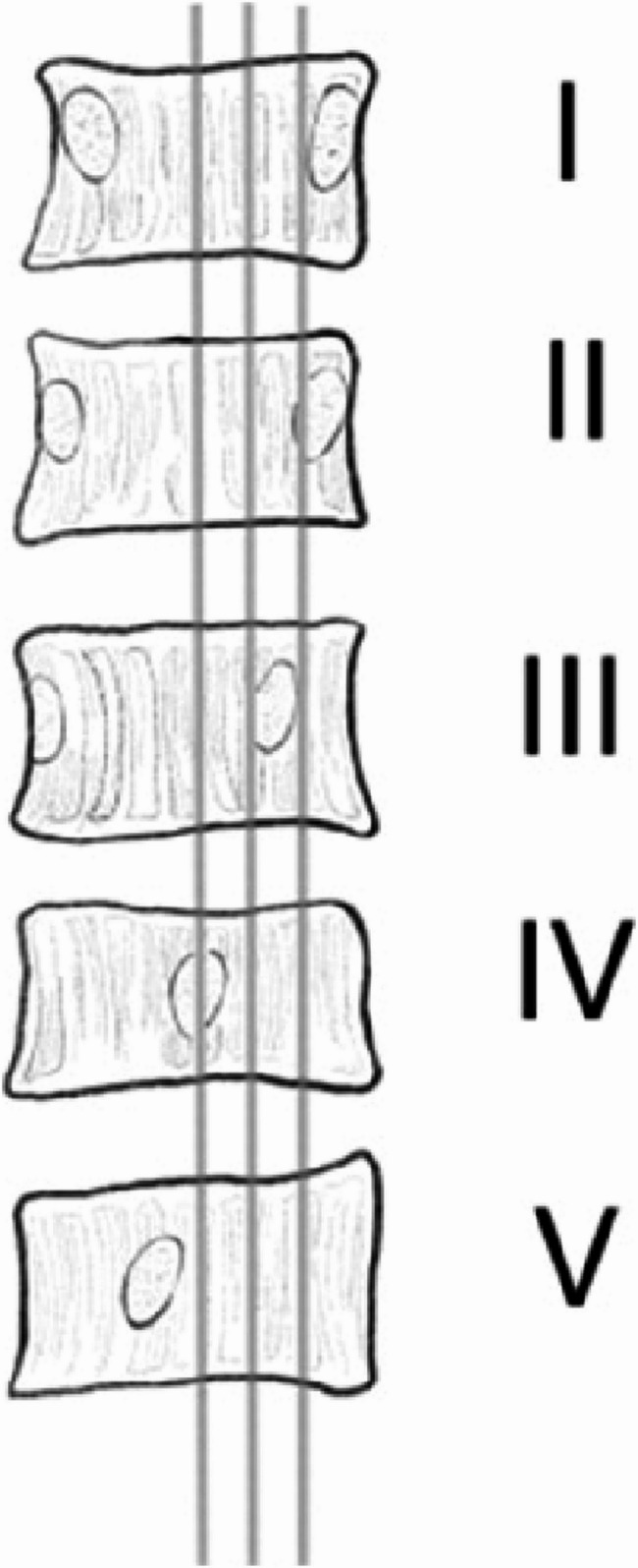 Nash-Moe Method for Measuring Vertebral Rotation Degrees. Degree I: The pedicles are symmetrical. Degree II: The pedicle on the convex side moves toward the midline without surpassing the first grading, while the pedicle on the concave side decreases in size. Degree III: The pedicle on the convex side has shifted to the second grading, while the pedicle on the concave side has disappeared. Degree IV: The pedicle on the convex side has shifted towards the center, while the pedicle on the concave side has vanished. Degree V: The convex side pedicle crosses the midline and approaches the concave side