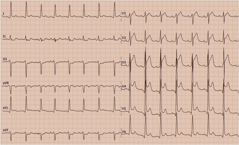 ECG after return of spontaneous circulation showing anterior and lateral ST segment elevation, with inferior ST segment depression.