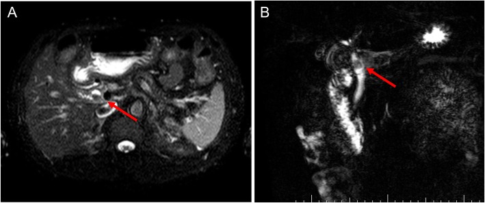 The findings of MRCP. It shows a filling defect (arrows) at the union of the cystic and common hepatic ducts (a, b)