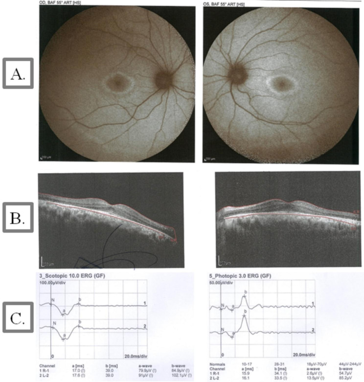 Fundus autofluorescence (FAF), optical coherence tomography (OCT) images, and electroretinography (ERG) in patient IV.1 with ABHD12 variants. (A) The eyes of a 25-year-old man with Snellen best-corrected visual acuity (BCVA) of 2/10. Fundus autofluorescence imaging showed typical ring-shaped macular alterations. (B) OCT showed preservation of the outer retinal layers in the fovea with outer retinal atrophy outside fovea. (C) ERG revealed a significant reduction in the amplitude of the scotopic and photopic recordings