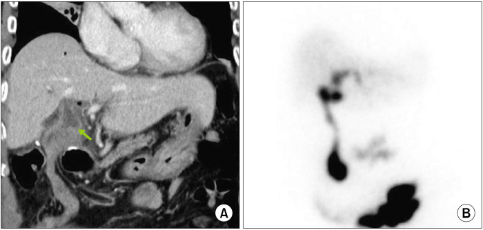 Postoperative findings at 10 days after surgery in Case No. 2. (A) Computed tomogra-phy shows uneventful drainage of the bile from to proximal common bile duct to the jejunal limb. (B) Hepatobiliary scinti-graphy shows a biliary excre-tion rate of 89.2% at 90 min-utes.