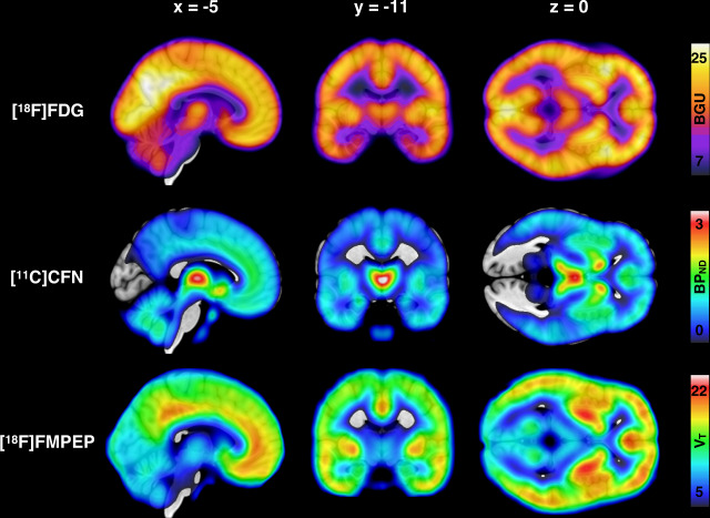 Mean distribution of brain glucose uptake, μ-opioid receptor availability and CB1 receptor availability in the whole study sample.Top: Mean brain glucose uptake (BGU) of the 38 [18F]FDG scans (19 low-risk and 19 high-risk subjects). Middle: Mean binding potential (BPND) of the 41 [11C]carfentanil scans (22 low-risk and 19 high-risk subjects). Bottom: Mean volume of distribution (VT) of the 36 [18F]FMPEP-d2 scans (20 low-risk and 16 high-risk subjects).
