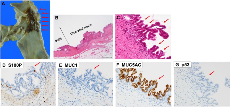 The macroscopic and pathological findings of the resected tumor. Arrows showing the irregular elevated mucosa with an ulcerated lesion of the resected tumor (a). The pathological examination of the resected tumor revealed that the ulcerated lesion had inflammatory granulation tissue but did not contain invasive carcinoma (b) (hematoxylin and eosin). Many consecutive intraepithelial micropapillary lesions spread around the ulcerated lesion (arrows), and the epithelial cells showed an increased nucleus-to-cytoplasm ratio, nuclear hyperchromasia, and architectural atypia (c) (hematoxylin and eosin, × 200). The pathological diagnosis was BilIN-1 to -2. Immunohistochemical staining showed that S100P was slightly expressed in the cytoplasm and MUC5AC was positive. MUC1 was negative and p53 was not overexpressed (d S100P, e MUC1, f MUC5AC, g p53) (× 200)