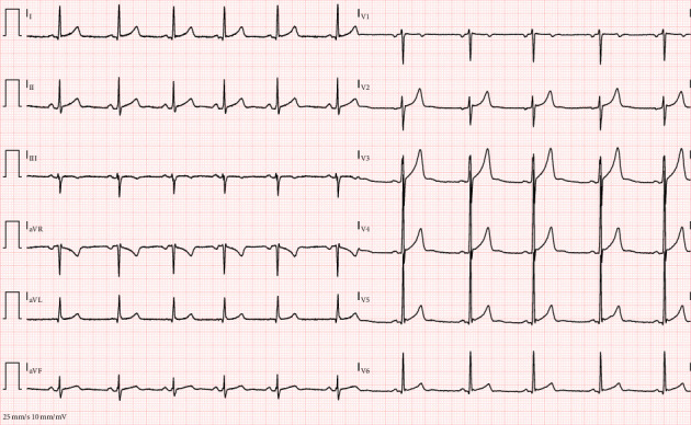 Second electrocardiogram after electrolyte imbalance correction: normalization of the QT interval and resolution of ST-T segment irregularities.