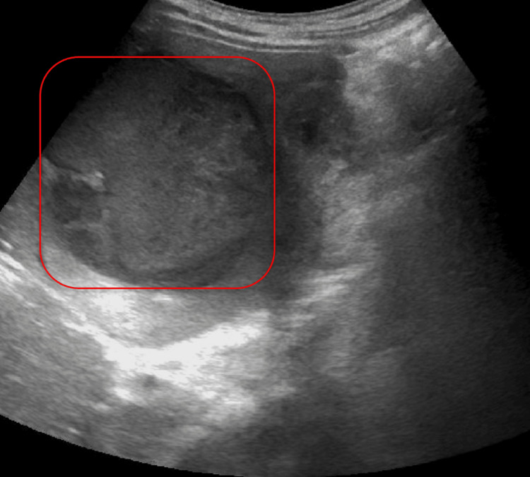 RUQ ultrasound with a complex fluid collection in the right hepatic lobe (red square). RUQ: right upper quadrant
