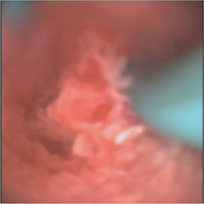 Lower end of the common bile duct with previously inserted pig tail catheter
