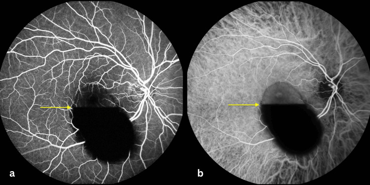 Fluorescein and Indocyanine Green Angiography of Premacular Subhyaloid HemorrhageFluorescein angiography (a) and indocyanine green angiography (b) of the right eye demonstrating a premacular hemorrhagic collection with a horizontal fluid–fluid level (arrow). The superior portion appears relatively translucent, allowing visualization of the underlying retinal vasculature on fluorescein angiography and the choroidal vasculature on indocyanine green angiography. In contrast, the inferior dependent portion is markedly hypofluorescent due to a masking effect from the dense hemorrhagic component, which obscures the underlying vascular structures. No evidence of retinal neovascularization, macroaneurysm, vasculitis, or other retinal vascular abnormalities is observed.
