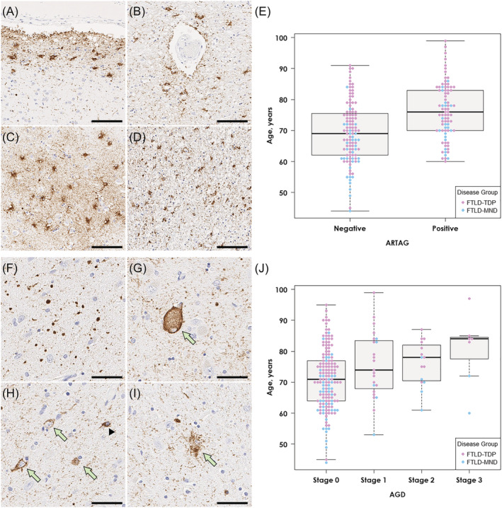 Representative images of ARTAG and AGD. (A–D, F–I) Immunohistochemistry for CP13. (A–D) Numerous thorn‐shaped astrocytes are observed in the subpial mediobasal region (A) and perivascular regions (B) and the grey matter (C) in the amygdala. Thorn‐shaped astrocytes are also present in the peri‐amygdaloid white matter (D). (E) Patients with ARTAG are significantly older than those without ARTAG across the three diseases. (F–I) The amygdala has numerous argyrophilic grains (F), along with balloon neuron (G), pretangles (H, arrows), coiled bodies (H, arrowhead) and granular‐fuzzy astrocytes (I), consistent with AGD. (J) Patients with AGD (stages 1–3) are significantly older than those without AGD (stage 0) across the three diseases. Scale bars: 50 μm in A–D and F–I