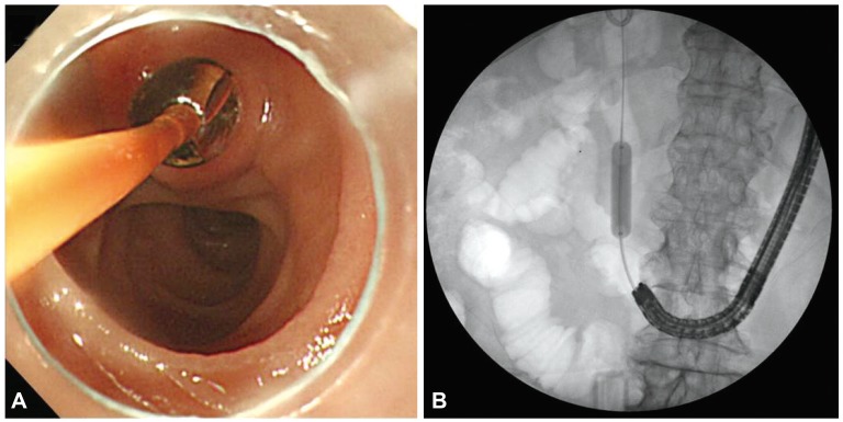 (A) Endoscopic view of a papillary balloon dilation through the transparent cap. The ampulla is seen in a reversed position in the cap-fitted forward endoscopic view in patients who had undergone Billroth II gastrectomy. (B) Endoscopic papillary balloon dilatation. The balloon is located over a guide-wire and inflated and dilation took 60 seconds.