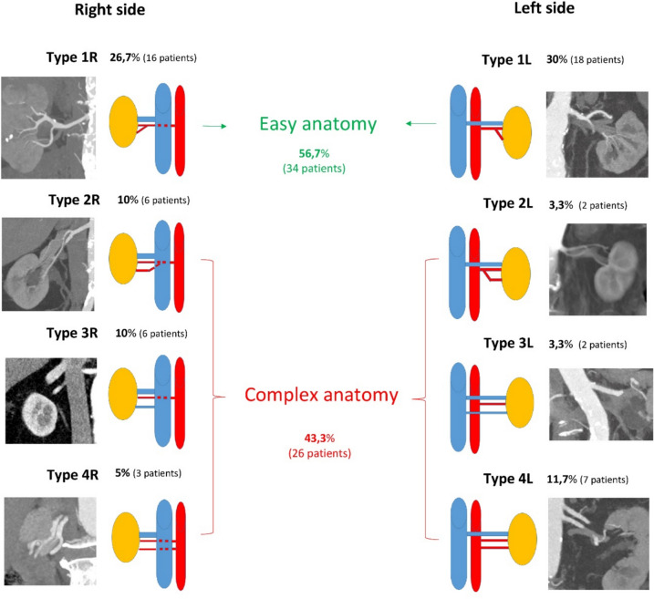 Vascular patterns identified on preoperative CT scan