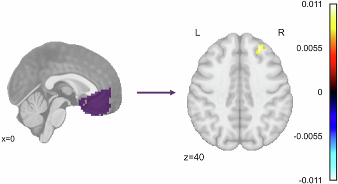 Change in clinician assessed PTSD symptoms between baseline and endpoint is significantly associated with functional connectivity between the vmPFC and the right dlPFC.Color bar depicts standardized β values for the effect of ΔCAPS in a model defined as ΔCAPS + Sex + Motion using AFNI’s 3dMVM. ΔCAPS was defined as endpoint CAPS – baseline CAPS. Significant cluster size was determined using a voxelwise threshold of p = 0.002 and cluster forming threshold of α = 0.05, corresponding to a cluster size of 11 voxels.