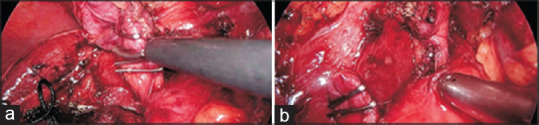 (a) Clipping of the cystic duct, (b) the clipped cystic duct and clipped cystic artery