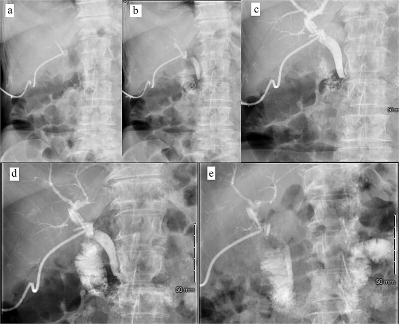 Postoperative tube study in ER. (a) Contrast injected into the cholecystostomy tube. (b) Contrast entering the CBD. (c) Contrast completely filling the CBD and intrahepatic ducts. (d) Contrast leaving the CBD and into the duodenum. (e) Contrast predominately in the small bowel.