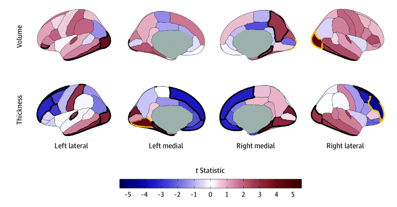 Regional Cortical Volume and Thickness Associations With Early Substance Use Initiation in the Adolescent Brain Cognitive Development (ABCD) StudyCortical volume and thickness patterning of associations with any substance use initiation are plotted as t statistics (red indicates a positive association and blue indicates a negative association) according to the Desikan–Killiany cortical atlas.31 Regions with bold yellow outlines were Bonferroni-significant for all study comparisons, and those with bold black outlines exhibited false discovery rate (FDR)–significant associations (eTable 3 in Supplement 1). Regional brain plots were constructed using the ggseg package in R.43