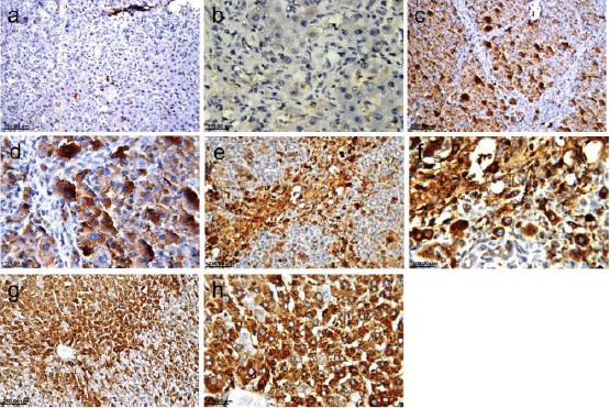 Immunohistochemical detection of α-FP (×40 & ×80). Sham group shows the negligible positive reaction of this stain (a & b), a noticeable increase in the reaction in BDL group (c & d) and silymarin treated group (e & f) and highest reaction in AM1241 treated group (g & h)