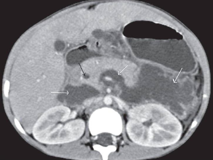 Transaxial contrast-enhanced CT scan shows a dilated intrapancreatic CBD (black arrow) and a large retroperitoneal collection on the left side of the abdomen, crossing to the right side and surrounding the superior mesenteric vein (white arrows)