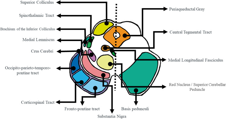 Diagram of the midbrain anatomy at the level of the superior colliculi. The diagram highlights the important contribution of the cerebral peduncles to the midbrain shape, which might turn these structures, rather spared in PSP, into “shape-preserving structures” in contrast to more large shape collapse of the pons in MSA due to more extensive pontine involvement in this condition