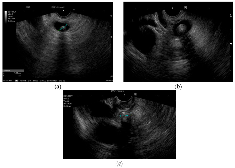 (a) Endoscopic ultrasound diagnostic of choledocholithiasis; (b) infracentimetric stones in the common bile duct; (c) stone impacted near the papilla in the common bile duct.