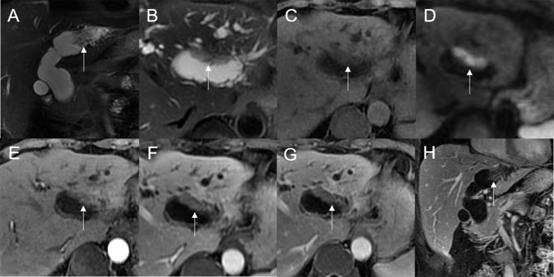 Adenoma in the left hepatic duct. The plaque-like mass (white arrow) shows isointensity on T2WI (A, B), isointensity on T1WI (C), and hyperintensity on DWI (D). The bile duct upstream, downstream, and at the lesion is dilated on coronal T2WI (A). T1-postcontrast arterial phase (E), portal phase (F), and delayed phase (G, H) all show slight enhancement.
