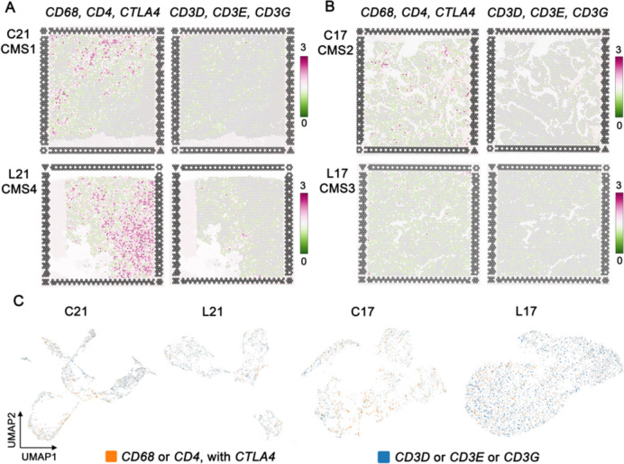 Distribution of the gene markers THC and tumor-immune cells. The maximum expression value (log2-transformed UMI counts) of CD68, CD4, and CTLA4, and CD3D, CD3E and CD3G (A) In patient 21; primary CRC classified as CMS4, C21 (above); liver metastasis classified as CMS4, L21 (below). (B) In patient 17; primary CRC classified as CMS2, C17 (above); liver metastasis classified as CMS3, L17 (below). (C) Feature plot of THC (CD68 or CD4 with CTLA4), and tumor-immune cells (CD3D or CD3E or CD3G) of each section; analysis size 6.5 × 6.5 mm