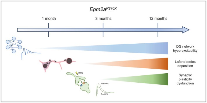 Network hyperexcitability as an early event in LD progression. Our results suggest that network hyperexcitability might represent one of the early pathogenic steps in LD, preceding synaptic deterioration and clear LBs or Aβ deposition. The schematic representation of LBs was made taking inspiration from the original drawing of LBs made by Lafora. 32
