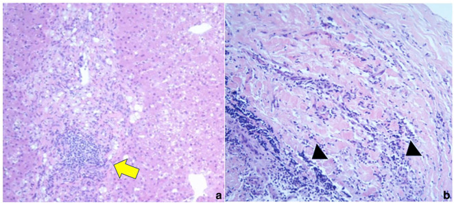 Histopathology of the tissue taken from the liver and common bile duct (CBD) sample. (a) Collagen fibre proliferation was observed around the portal triads in the liver, indicating moderate fibrosis. Moderate infiltration of inflammatory cells, predominantly lymphocytes, was noted around the bile ducts, with necrotic and exfoliated epithelial cells present within the bile duct lumen (yellow arrow). Hepatocytes exhibited diffuse vacuolar degeneration, accompanied by the deposition of greenish-brown pigment. (b) In the CBD wall, marked infiltration of lymphocytes was observed in the submucosal tissue (black arrowheads). A small number of macrophages were also present, along with cellular debris in the surrounding area