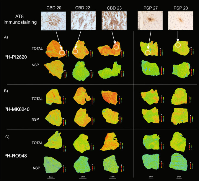 Comparative 3H-PI2620, 3H-MK6240 and 3H-RO948 autoradiography and corresponding AT8 staining on small frozen post-mortem frontal brain sections from CBD and PSP patients.Autoradiography was carried out on small frozen adjacent frontal cortex sections from CBD and PSP patients using A 3H-PI2620 (1 nM); B 3H-MK6240 (1 nM); and C 3H-RO948 plus 1 μM of unlabelled PI2620, MK6240 and RO948, respectively. Autoradiography colour/brightness threshold levels were set the same for the three tracers: 3H-PI2620 standards: + = 5898.5 fmol/mg, ‒ = −5.7 fmol/mg; 3H-MK6240 standards: + = 5555.9 fmol/mg, ‒ = −3.1 fmol/mg; and 3H-RO948 standards: + = 8181.5 fmol/mg, − = −0.3 fmol/mg. For each tracer, the upper row represents total binding, and the lower row represents NSP binding. AT8 (pS202/pT205) staining (1:1000) performed on adjacent frozen frontal cortex sections from CBD patients 20, 22, and 23, and PSP patients 27 and 28 are presented as pathology references (magnification ×40 for all images). The same scale was used for all CBD (40μm) and PSP (20 μm) samples. CBD corticobasal degeneration, NSP non-specific, PSP progressive supranuclear palsy.