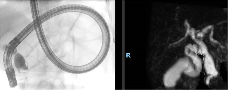 ERCP compared with MRCP.