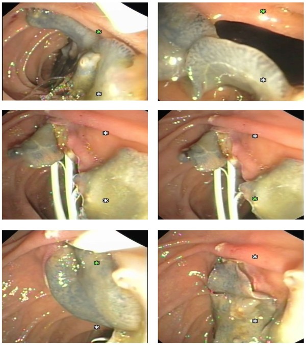 In another patient, 14 live Fasciola hepatica worms escaped from C.B.D. during endoscopic sphincterotomy / ERCP.