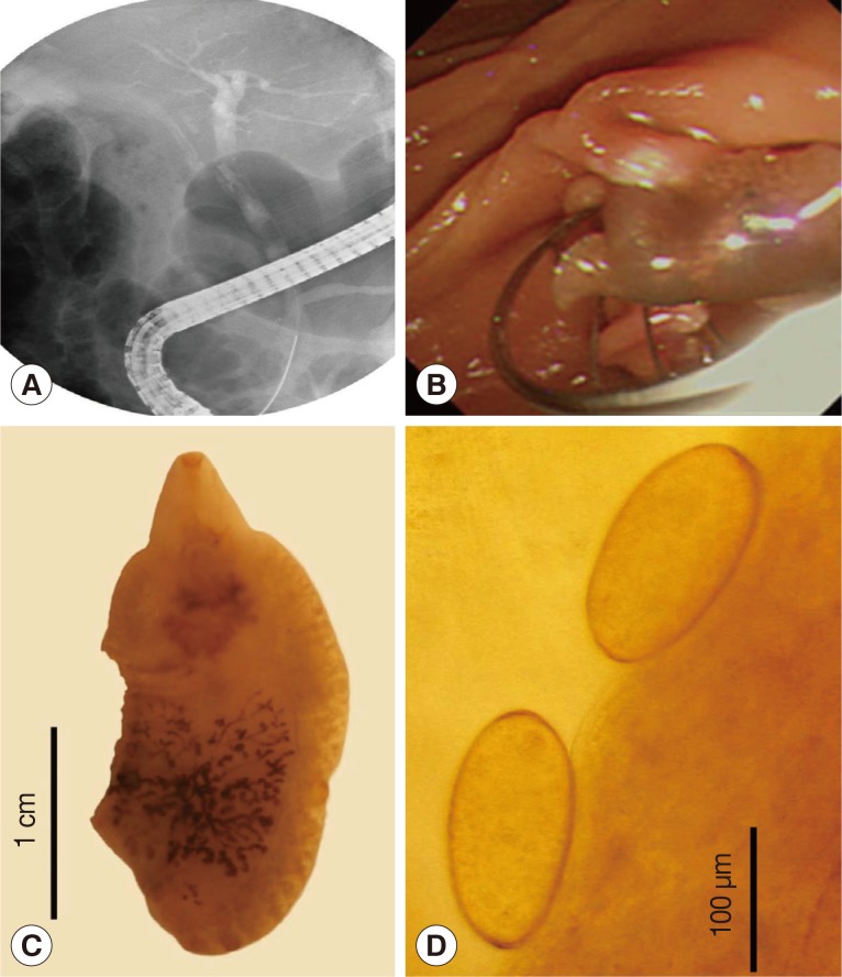 ERCP findings (A, B), Fasciola hepatica adult worm (C), and eggs (D). (A) ERCP showing a linear filling defect within the mid-portion of the common bile duct (CBD). (B) After endoscopic sphincterotomy, a live F. hepatica worm could be removed. (C) An adult worm of F. hepatica recovered from this patient, damaged partially. (D) Two eggs of F. hepatica extracted from the uterus of a worm from this patient.