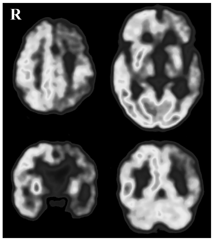 [18F]-deoxyglucose brain positron emission tomography study of the patient shows markedly reduced glucose metabolism in the left fronto-temporo-parietal cortex, left striatum and left thalamus.